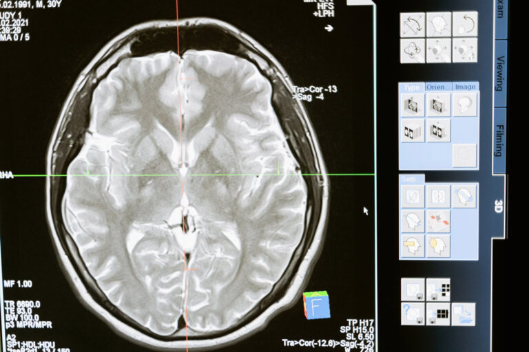 Revolutionary brain implant helps blind patient see without eyes for the first time in 16 years