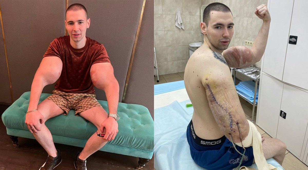 Man who INJECTED OIL into his biceps now at risk of losing his rotting arms