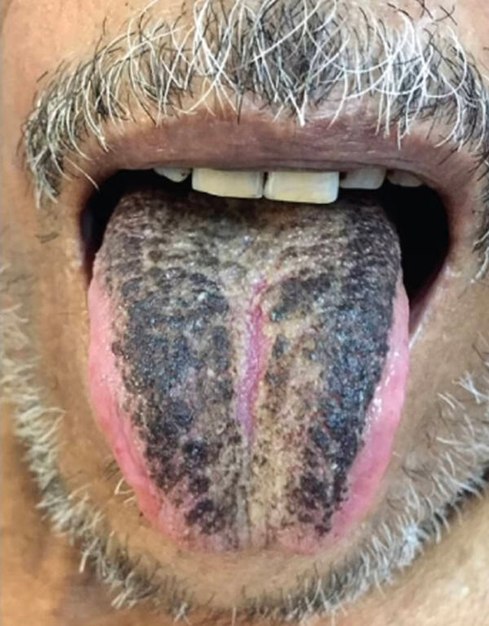 You’ll never guess why this man woke up with a BLACK and HAIRY tongue
