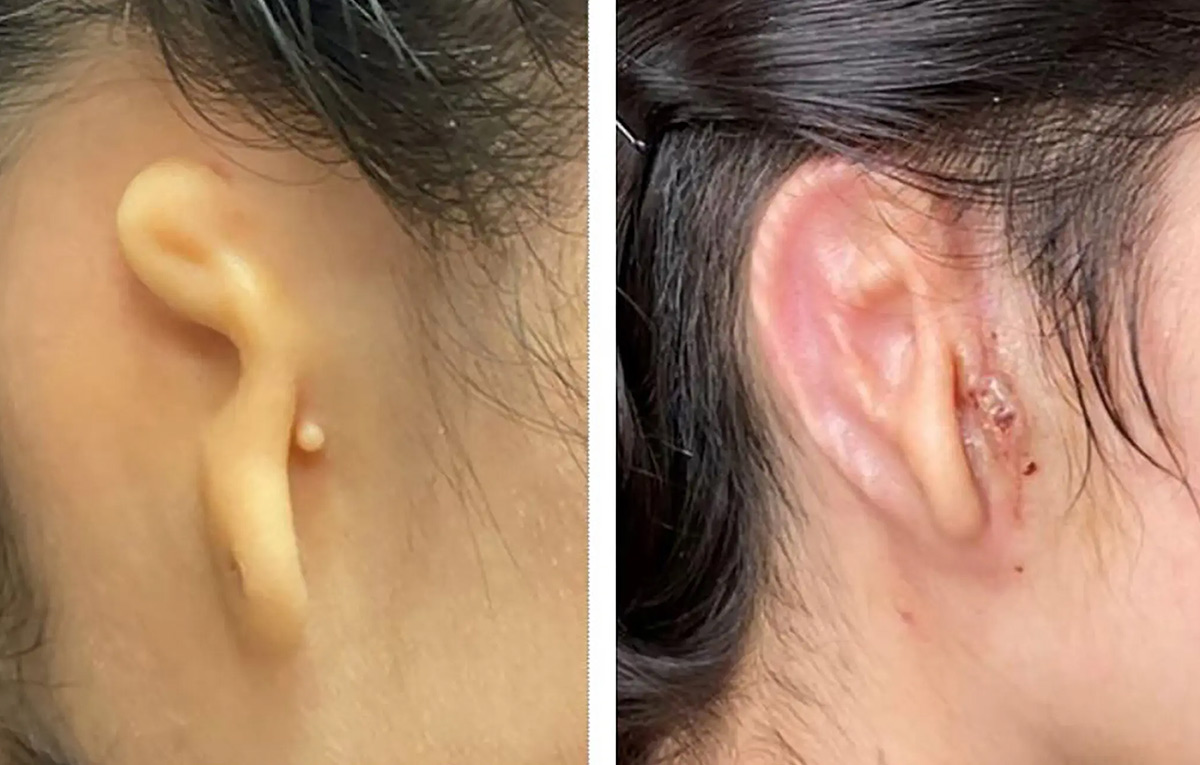 Woman receives living 3D-printed ear implant made of her own cells in ‘world-first’ transplant