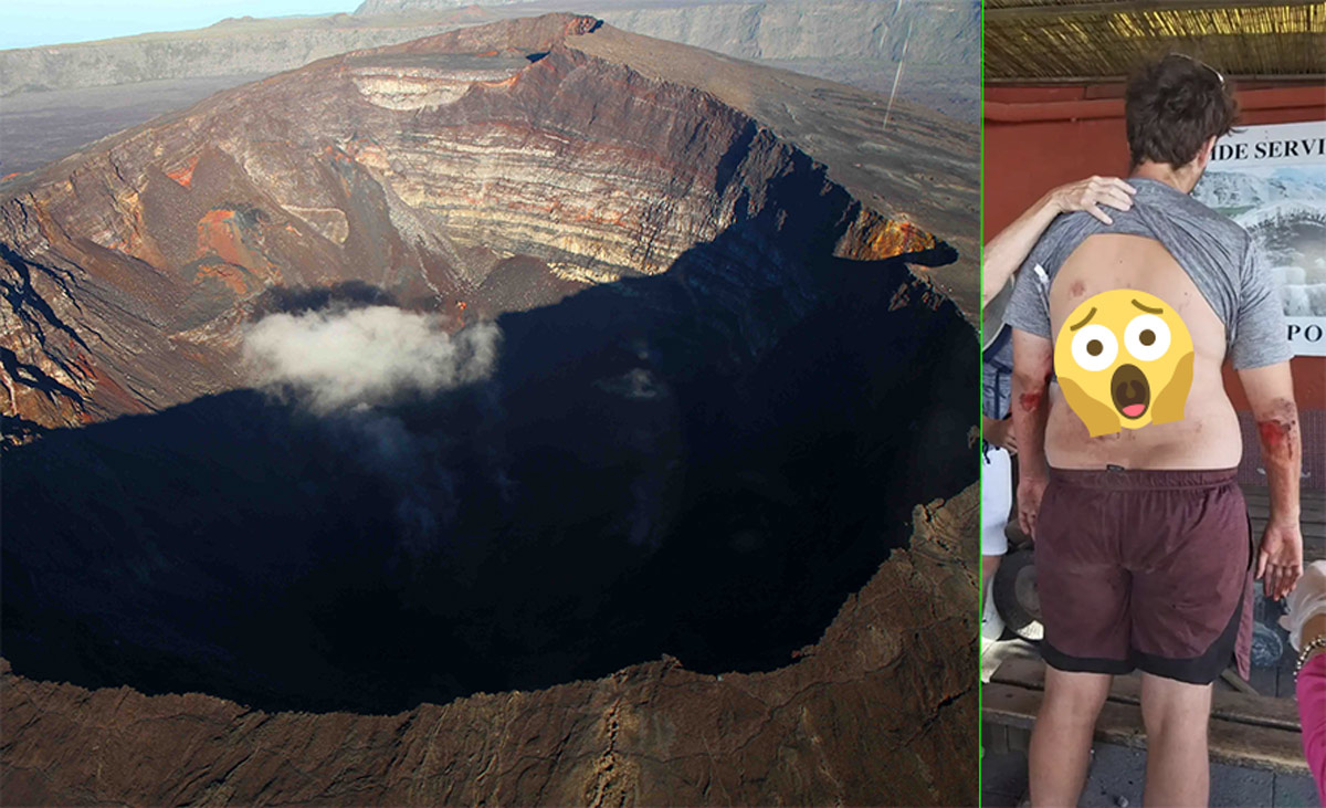 Man who fell down Mount Vesuvius taking a selfie shows off his injuries after being rescued