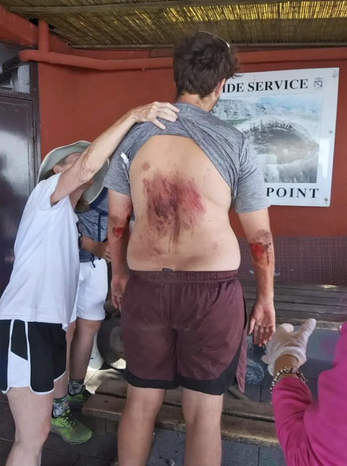 Man who fell down Mount Vesuvius taking a selfie shows off his injuries after being rescued