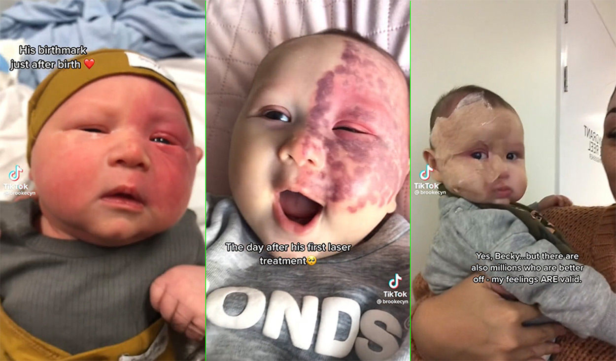 Mum slammed by followers for removing her baby’s birthmark with laser treatment
