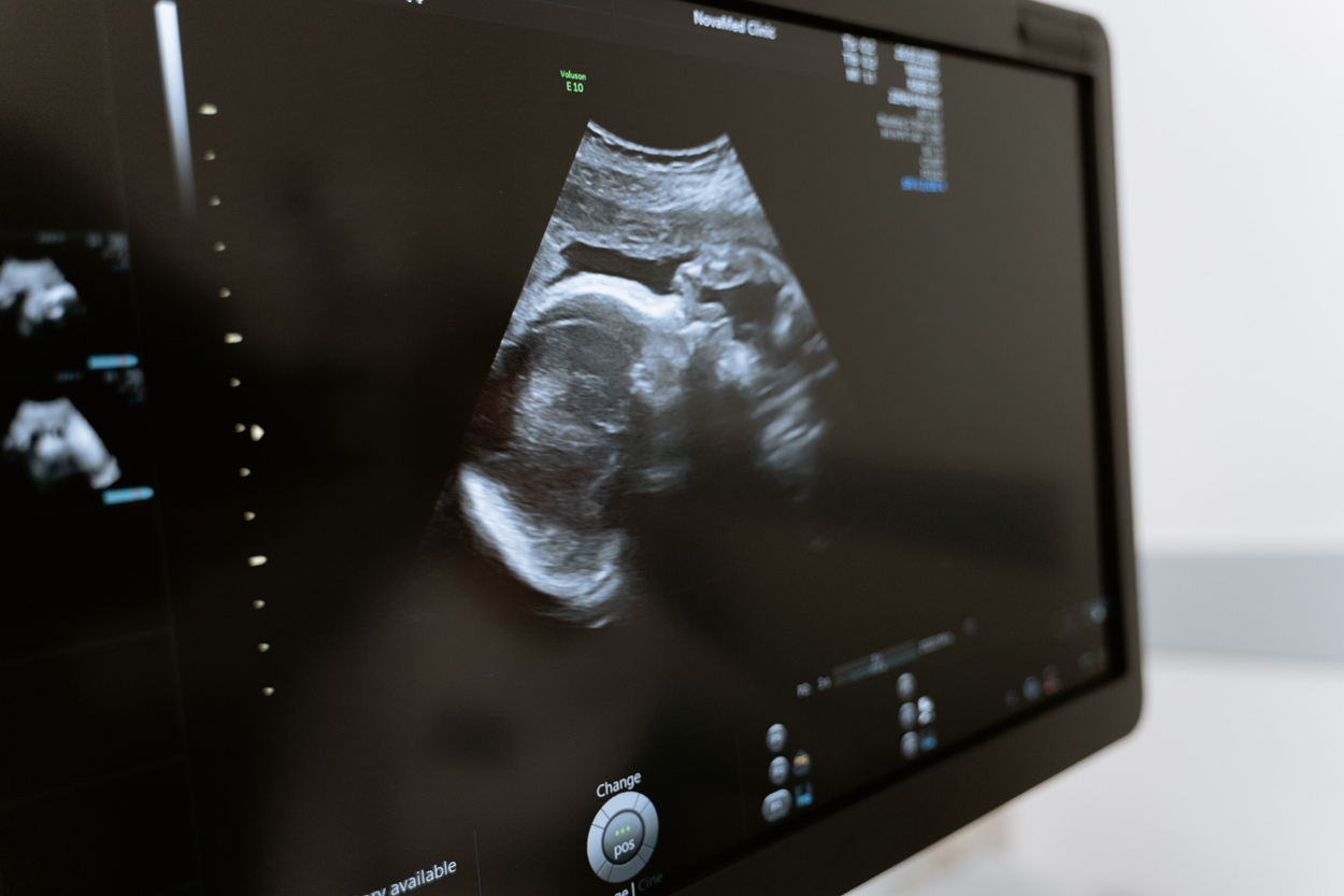Hungarian women will be forced to hear foetus’ heartbeat before getting an abortion