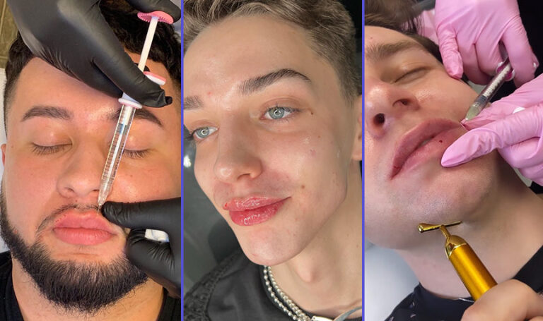 Men are warming up to lip fillers and finding more than just one use for the injections